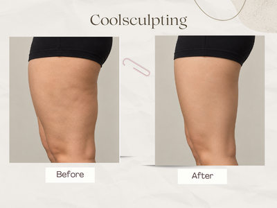 Love handles and flank fat freezing result