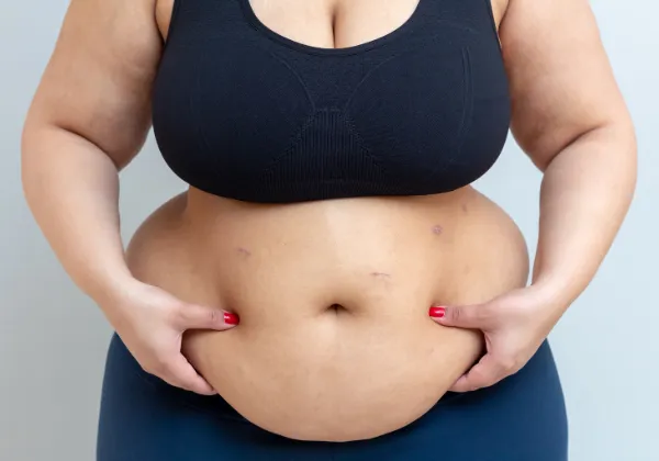 Belly (Abdomen) coolsculpting treatment