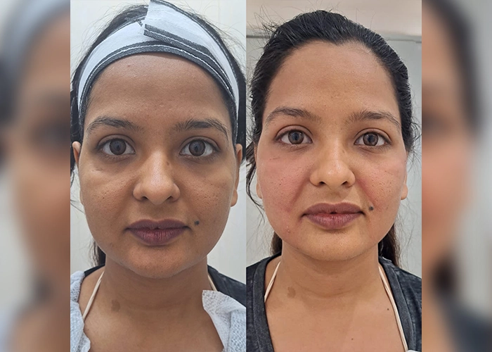 Face Lifting Treatment In Delhi