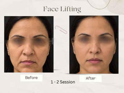 Anti-ageing before and after result