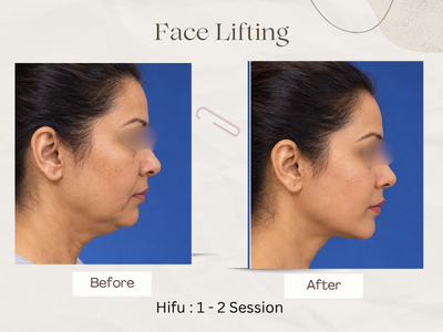 Anti-ageing treatment before after