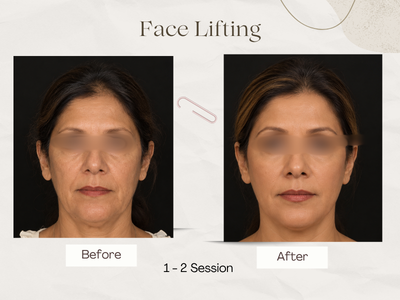 Wrinkle reduction before and after