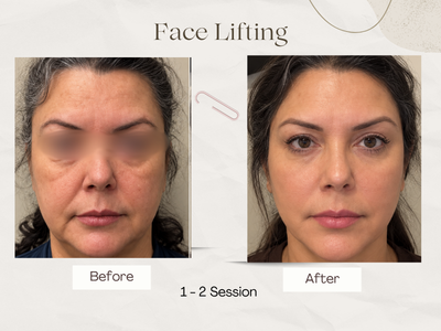 Anti-ageing skin rejuvenation result