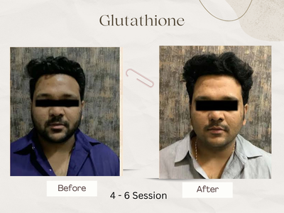 Glutathione Injection Cost & Treatment by Dr. Geetika (AIIMS, Delhi)