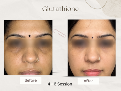 Glutathione Injection Cost & Treatment by Dr. Geetika (AIIMS, Delhi)