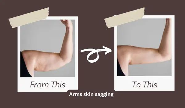 hifu one session before and result