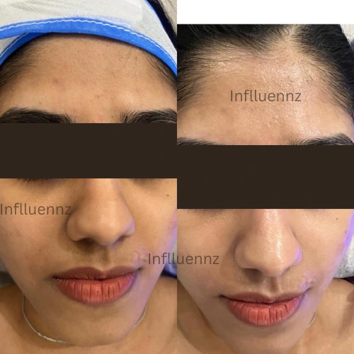 glutathione hydra facial Best Hydrafacial in Delhi : AIIMS Expert