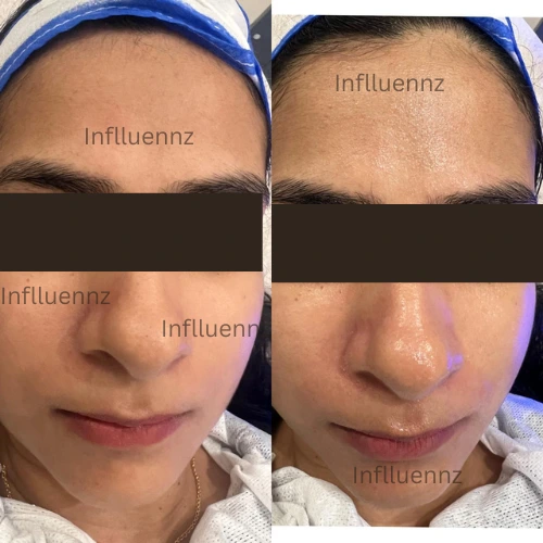 Hydrafacial one session before and result
