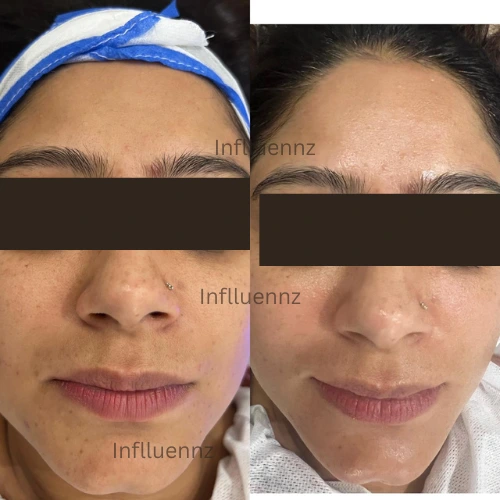Hydrafacial before after