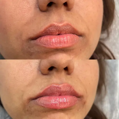 Lip fillers before and after result
