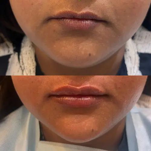 Lip filler before after