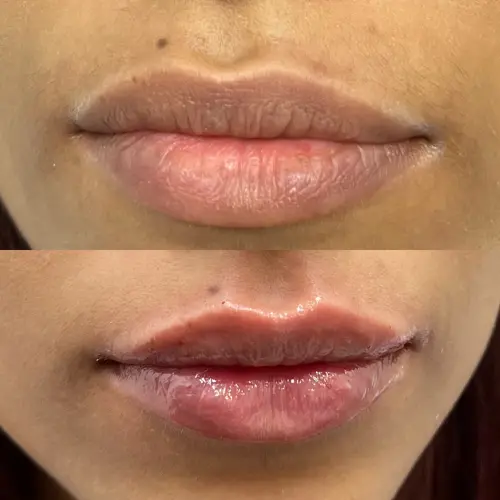 Lip filler result delhi