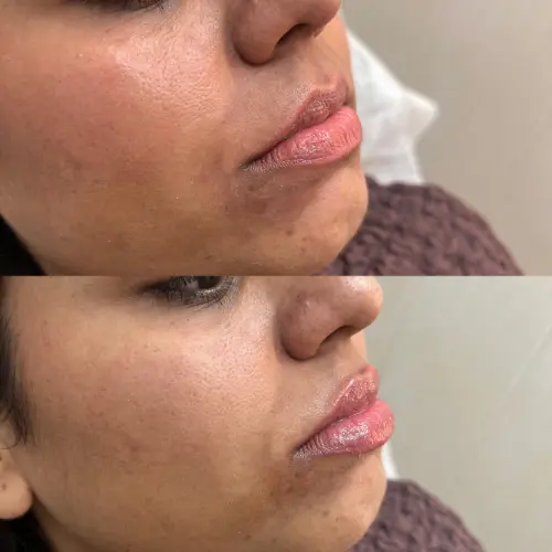 Lip augmentation before and result
