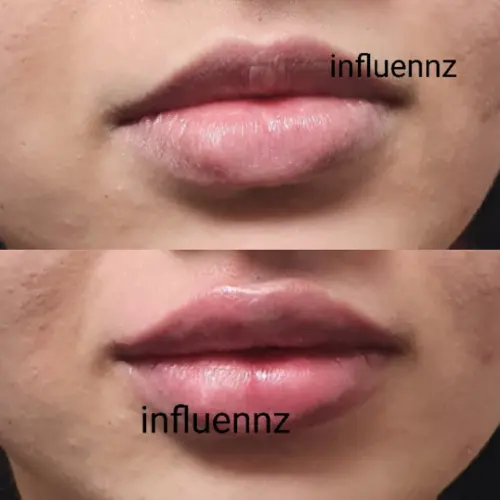 Lip augmentation before after delhi