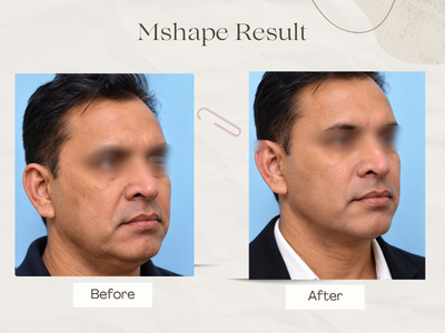 Anti-ageing before and after result