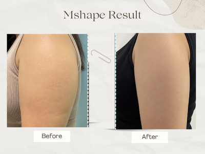 Facial contouring and skin tightening before after
