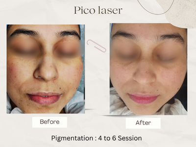 Anti-ageing before and after result