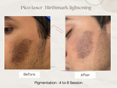 Wrinkle reduction before and after
