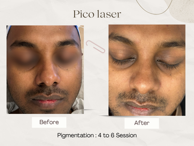Anti-ageing skin rejuvenation result
