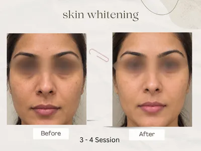 Anti-ageing before and after result