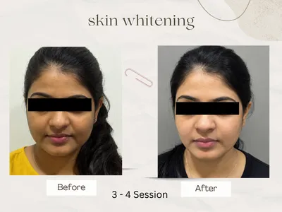 Anti-ageing treatment before after