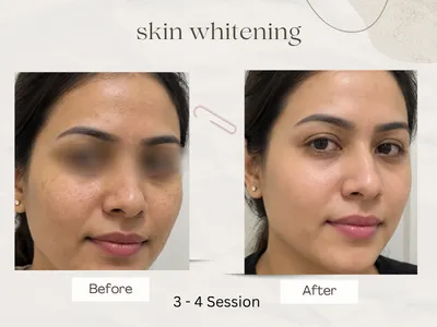Wrinkle reduction before and after
