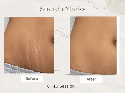 stretch marks before and after result