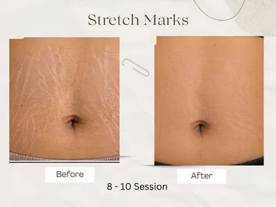 stretch marks treatment before after