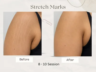 stretch marks result Delhi