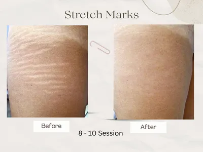 stretch marks result