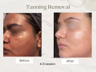 Tan Removal before and after result