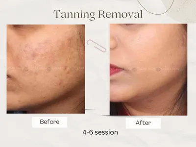 Tan Removal treatment before after
