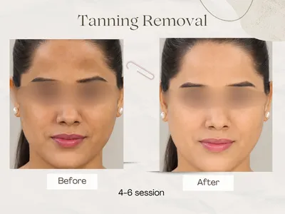 Tan Removal result Delhi