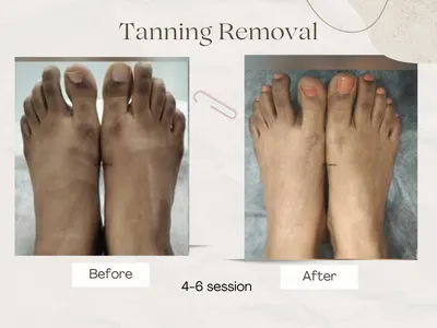 Tan Removal result