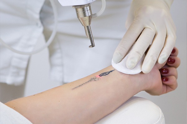 Tattoo Removal in Delhi