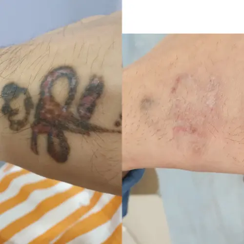 glutathione tattoo removal Glutaxim - 1200mg Glutathione Injection | Medicine Grade Liquid Form,  Prescription Required for Hospital and Clinic Use at 4000.00 INR in Pune main image 1