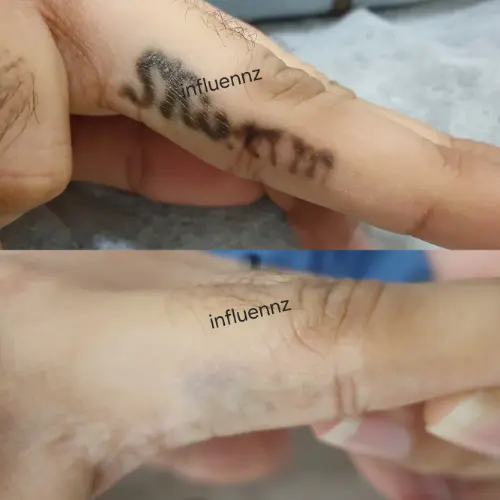 Laser Tattoo Removal Cost in Delhi