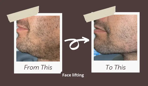 Thread Lift before and after result