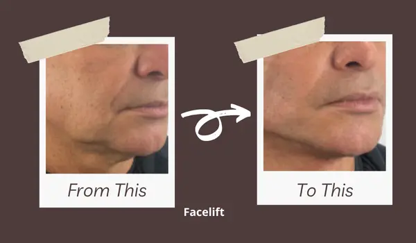 Thread Lift before after