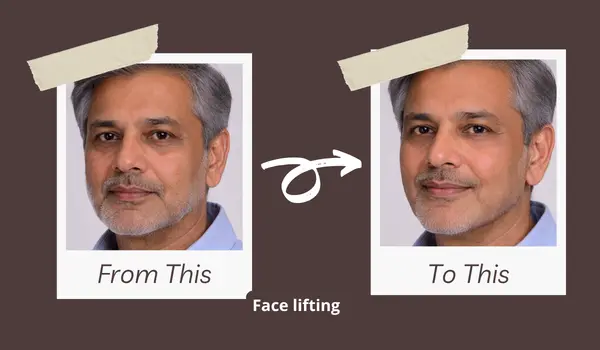 Thread Lift before and result